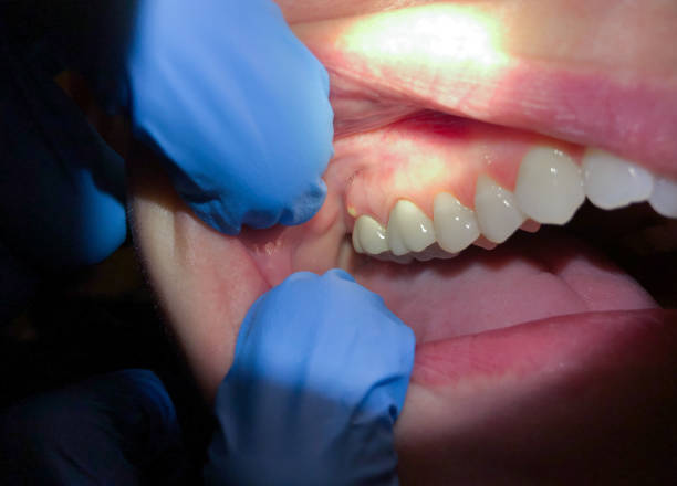 Best Emergency Treatment for Dental Infections or Abscesses in Chandler, IN